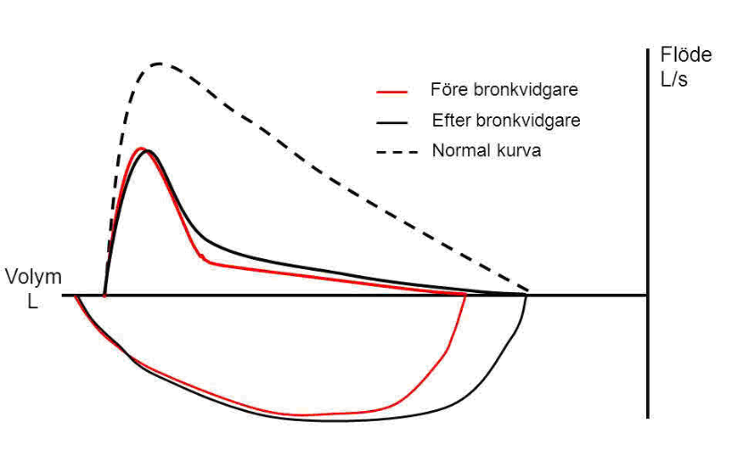 G:\Kansli\FS-Avdelningen\FAKTA\ÖFaktasidor från plussidorna 2022\Lungor och allergi\KOL-kurva_bild.bmp