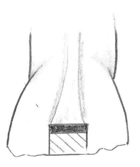 komplicerad kronfraktur, stor lesion