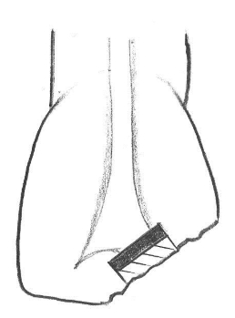 komplicerad kronfraktur, liten lesion