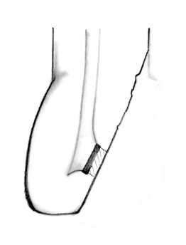 komplicerad kron-rotfraktur, liten lesion