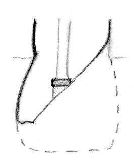 komplicerad kron-rotfraktur, stor lesion