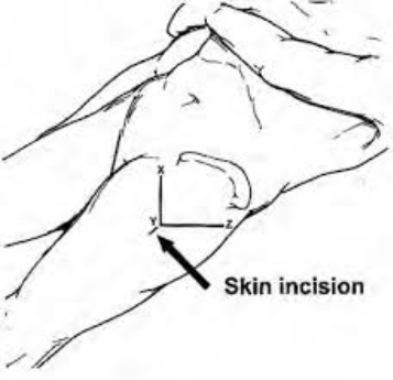 H:\Skrivbord\SCFE entry point.jpg