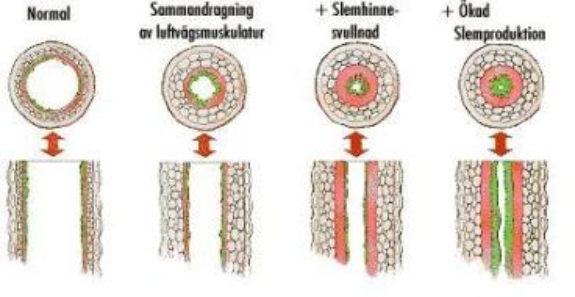 Genomskärning av luftrör
